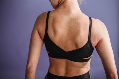 Biologics for Psoriasis: What the First Year Really Looks Like